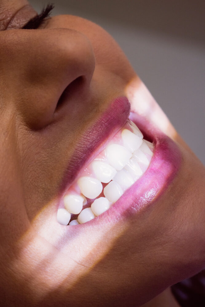 Clareamento Dental a Laser - Clínica Dal Molin